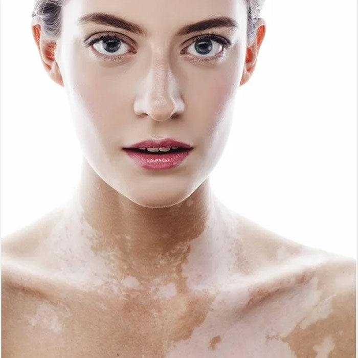 Body pigmentation Skin Concern