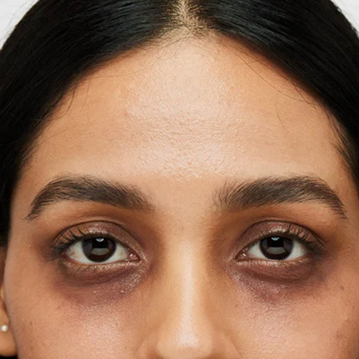 Dark Circles