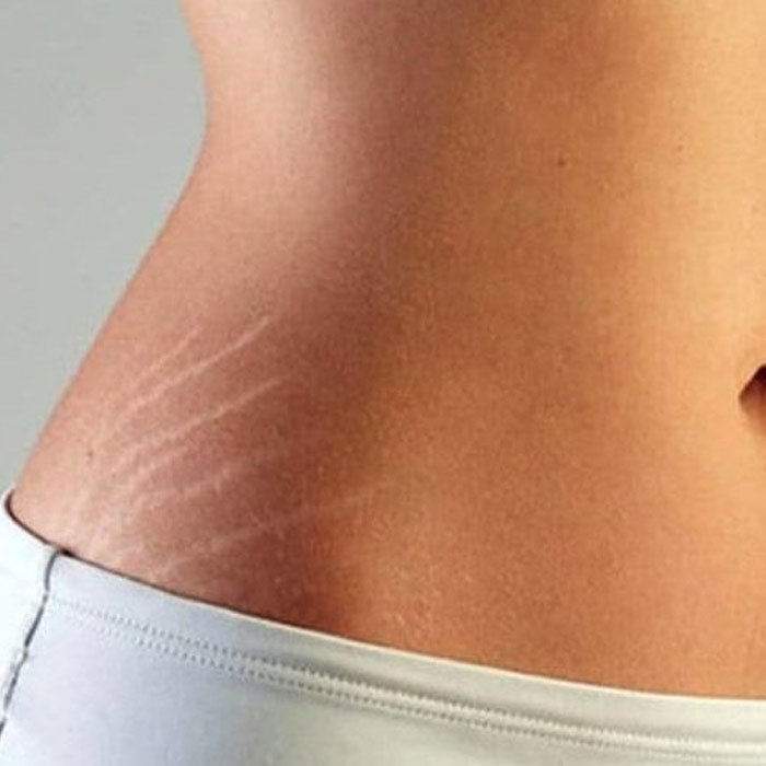 Stretch Marks Shop By Skin Or Hair Concern