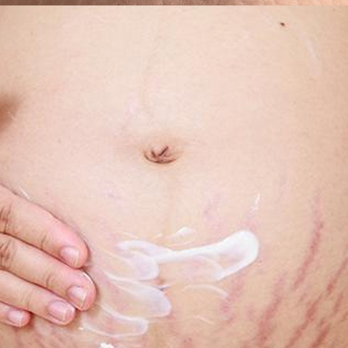 Stretch Marks