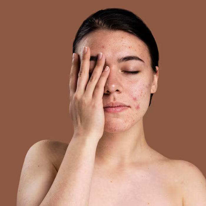 Acne Treatment