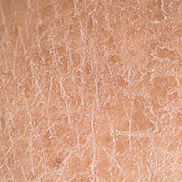 Dry Skin